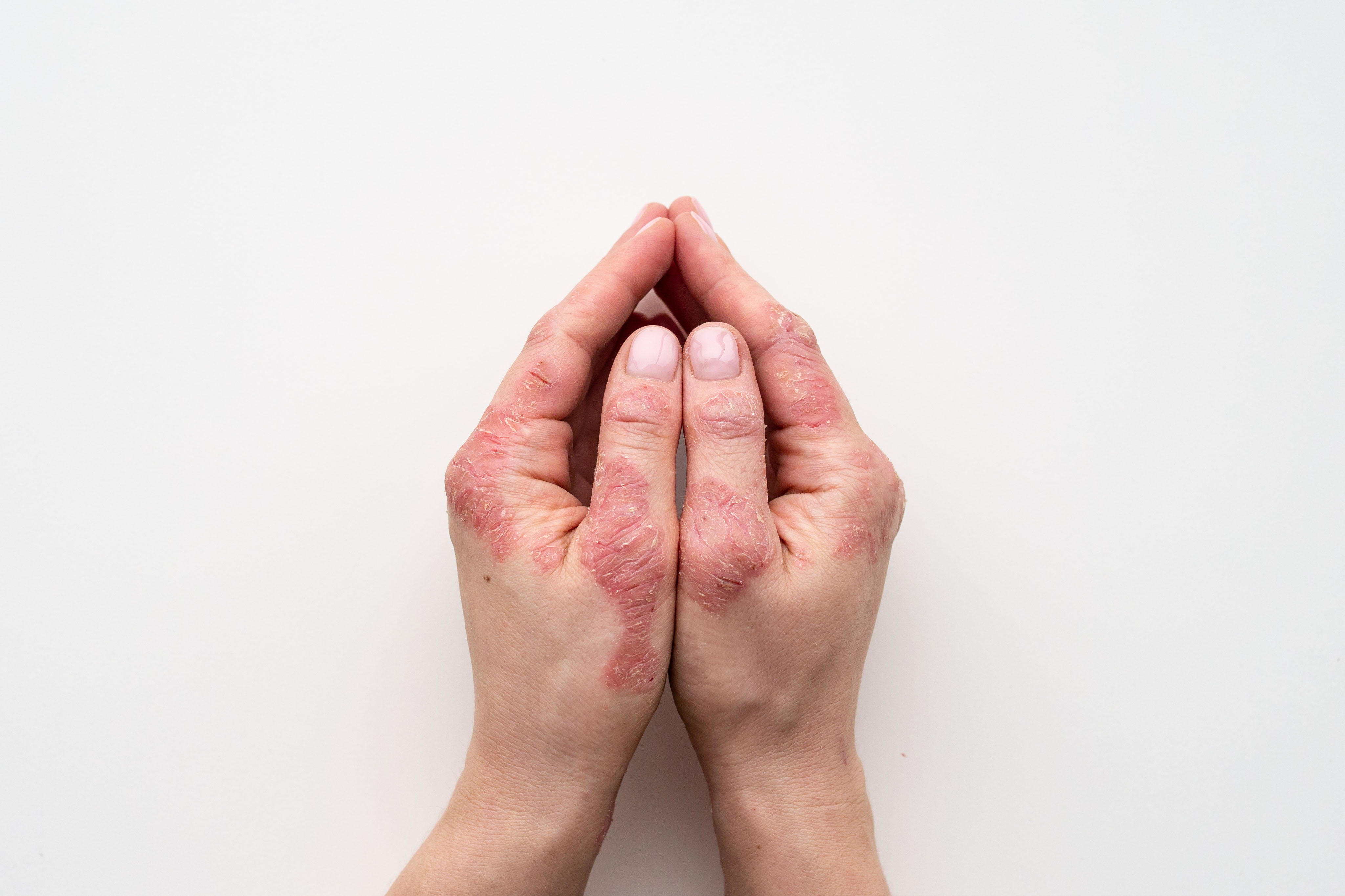 Psoriasis op moeilijk behandelbare zones