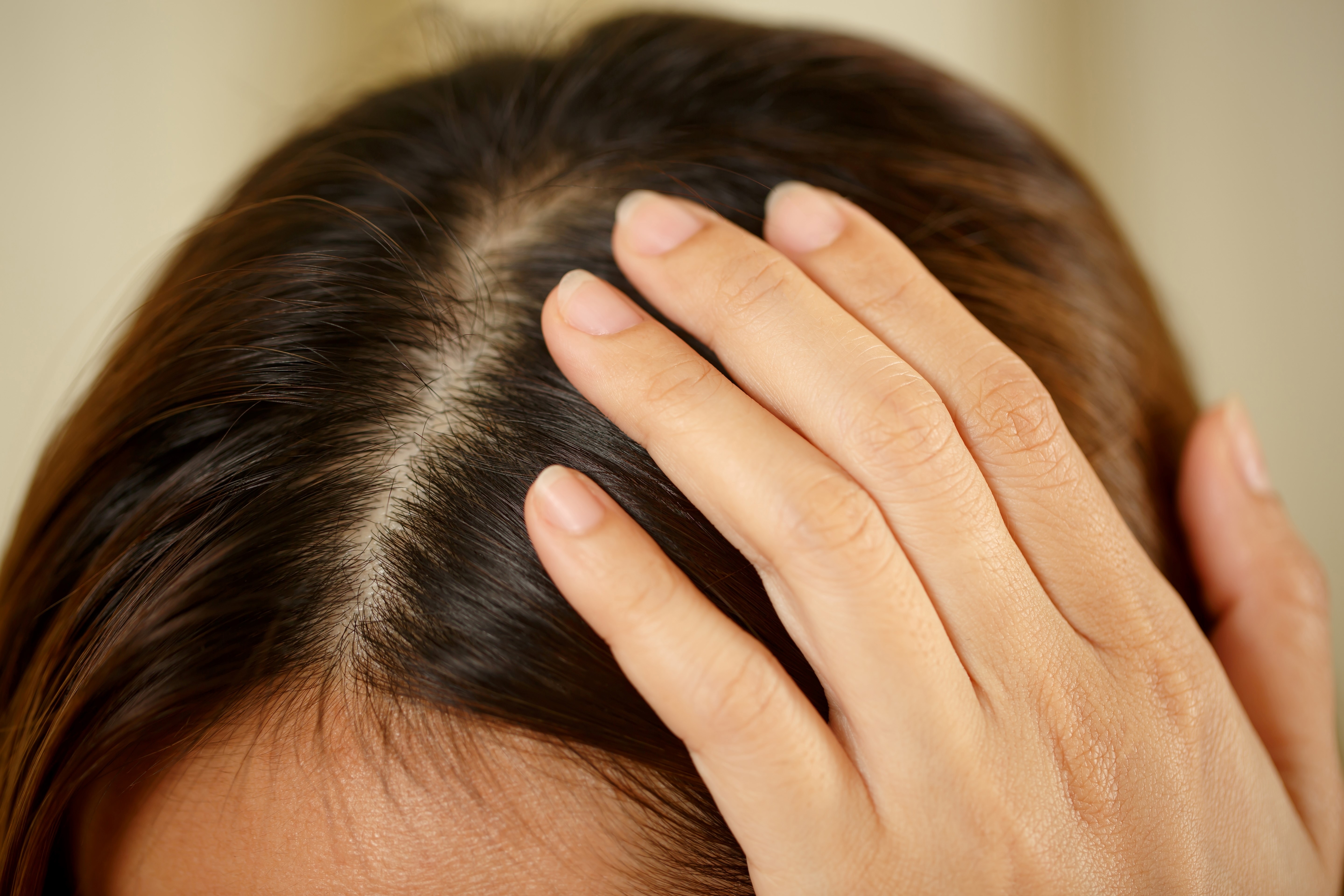 Psoriasis van de hoofdhuid: het zit niet in je hoofd, maar erop