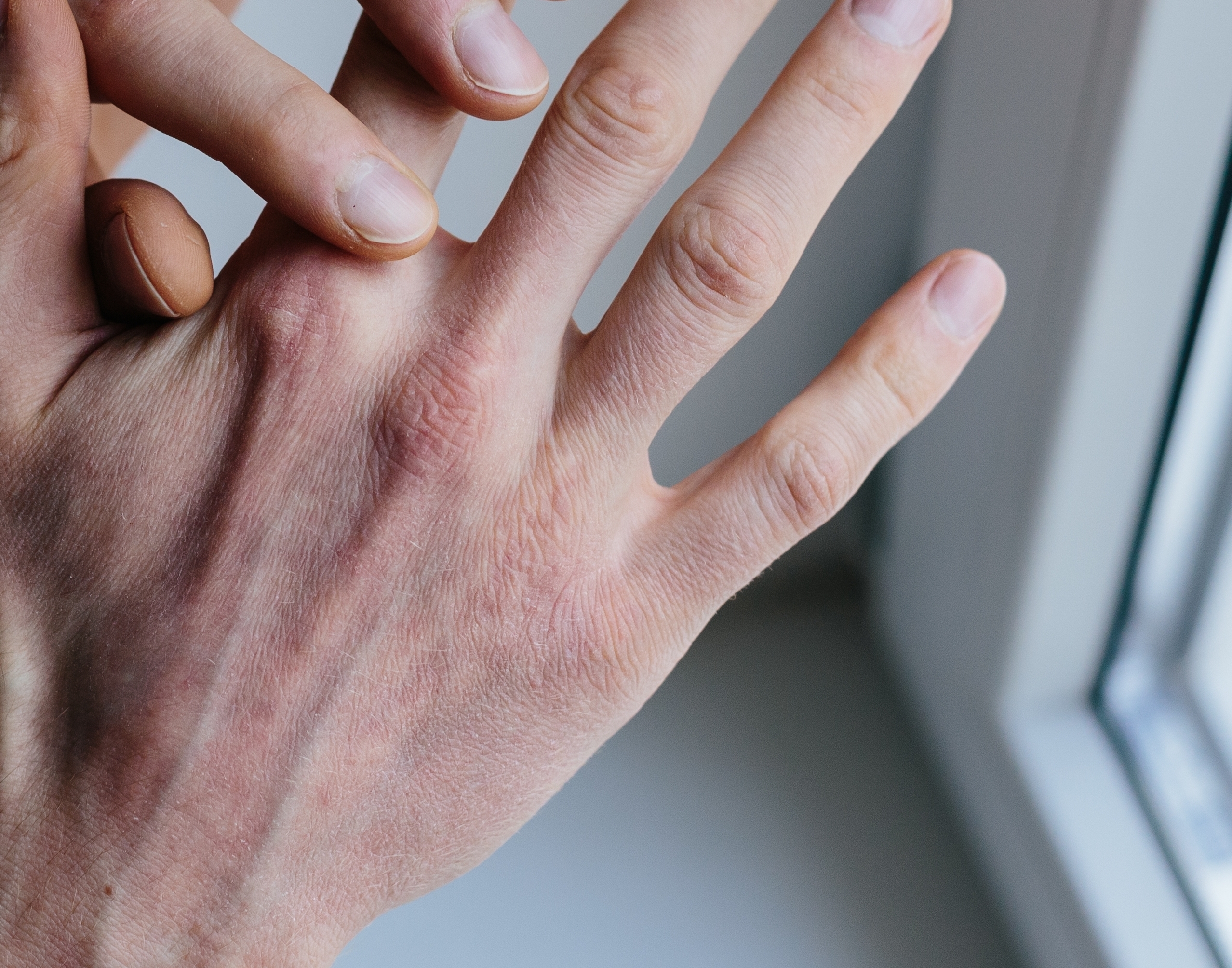 Hoe krijg je psoriasis?