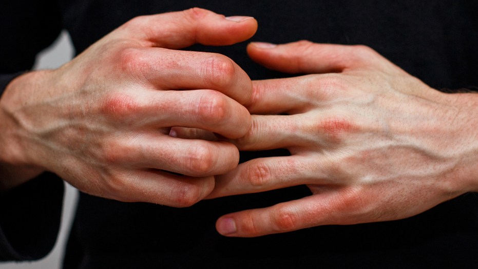 Psoriasis is niet langer onoverkomelijk