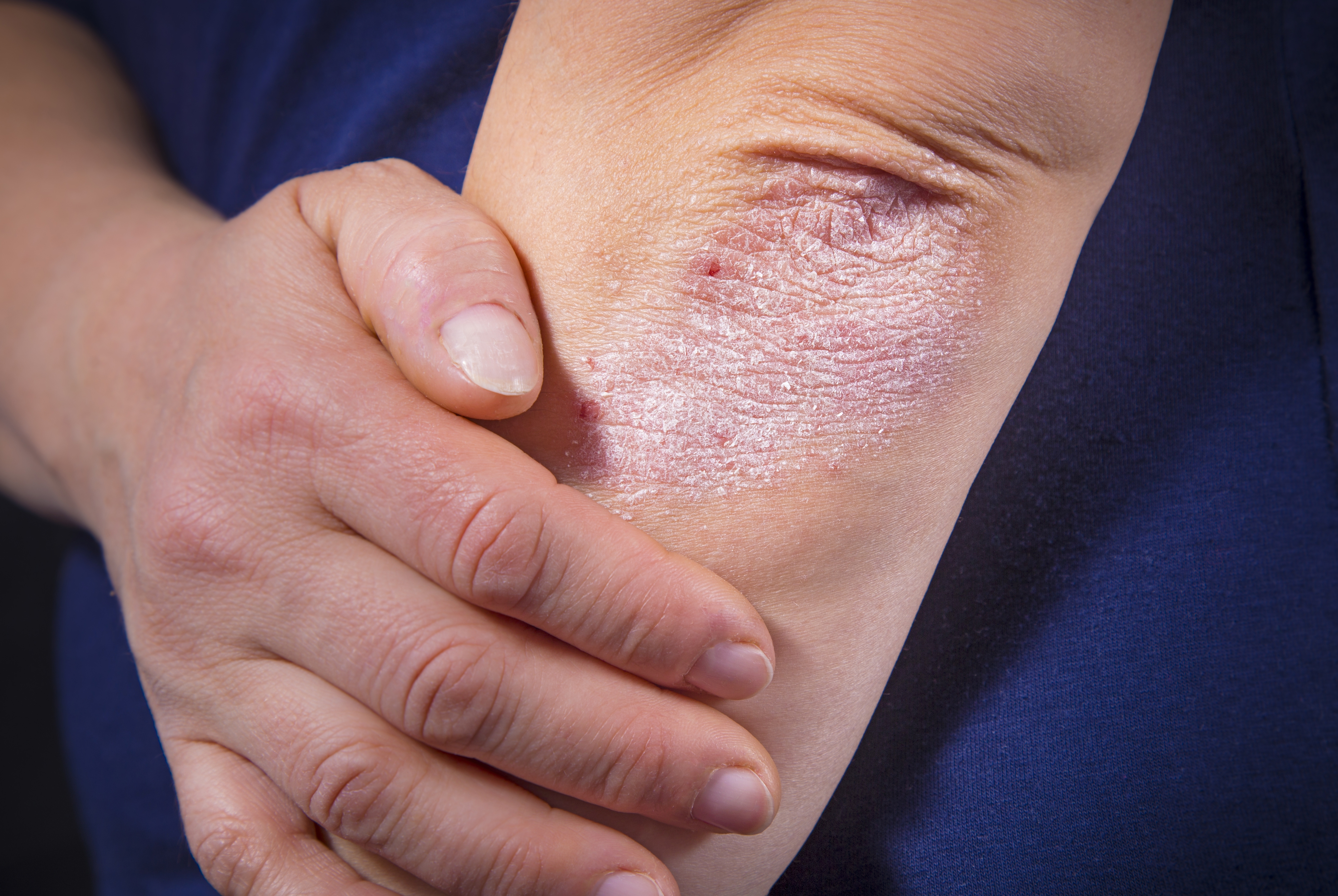 Kun je genezen van psoriasis?