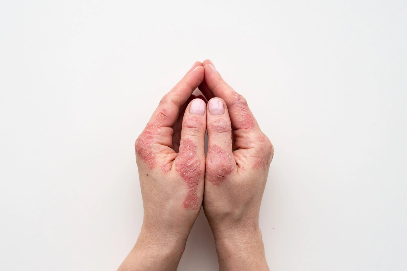 Psoriasis op moeilijk behandelbare zones