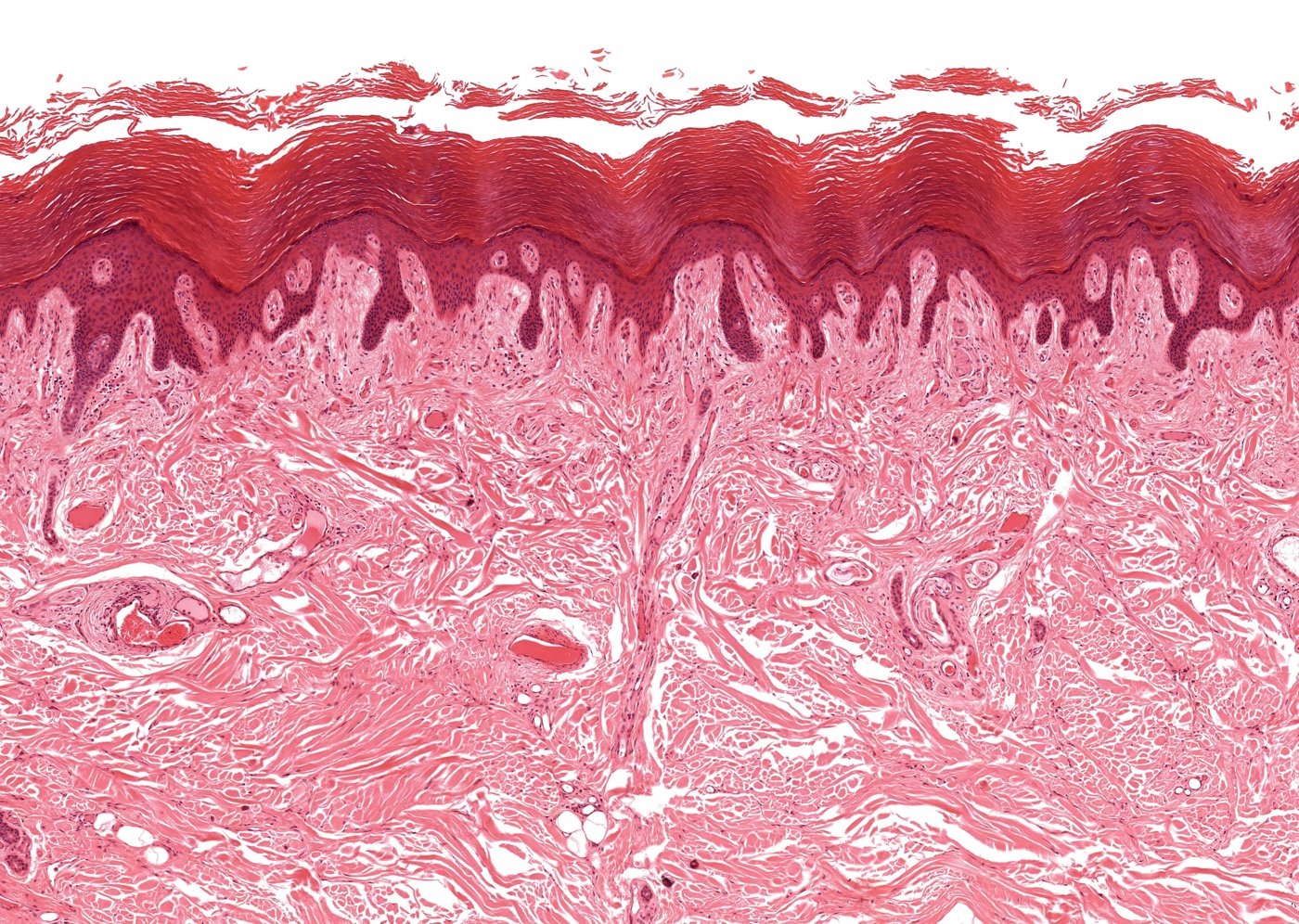 Psoriasis: meer dan alleen de huid