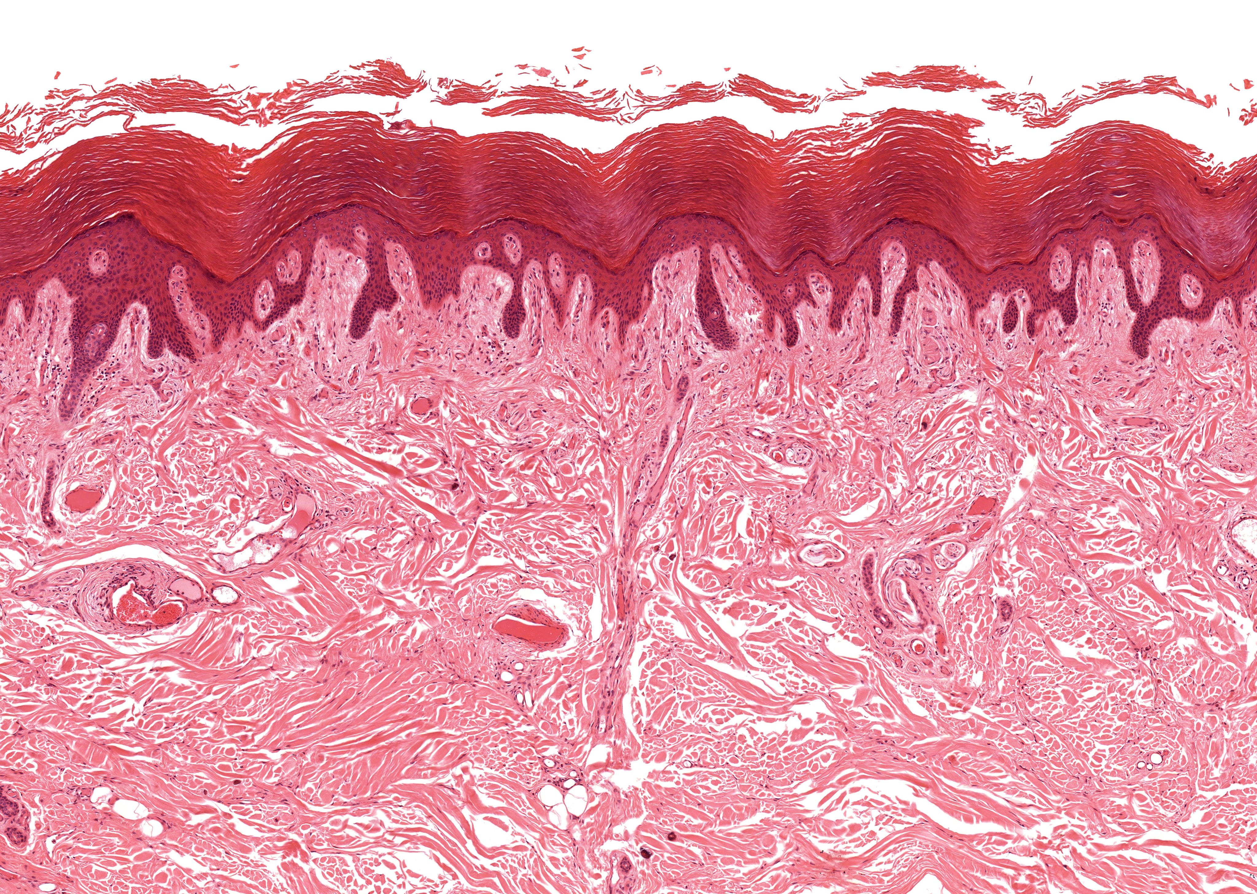 Psoriasis: meer dan alleen de huid